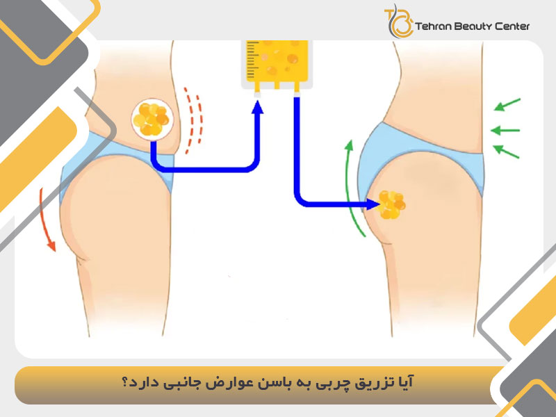 تزریق چربی به باسن