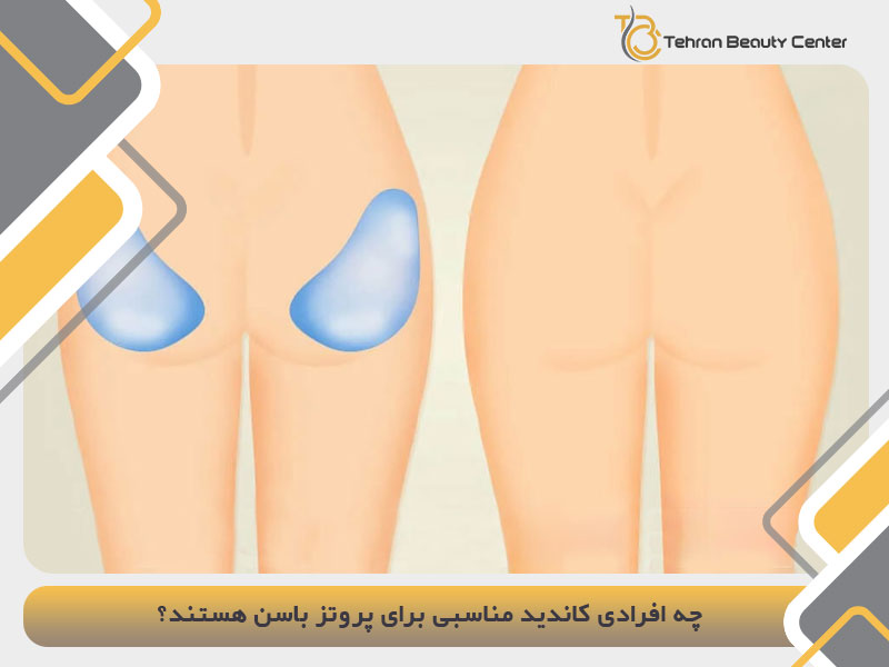 چه افرادی کاندید مناسبی برای پروتز باسن هستند؟