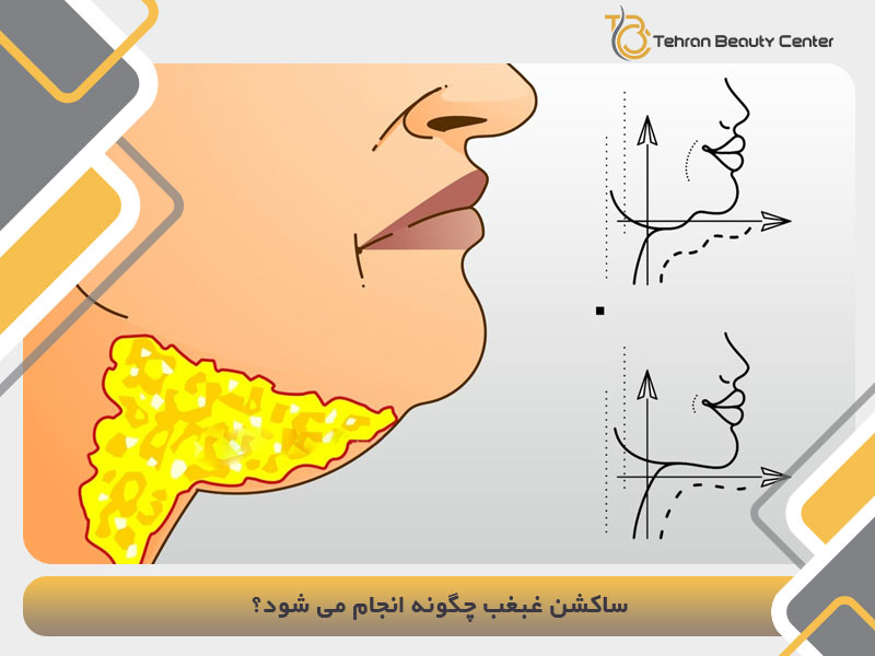 ساکشن غبغب چگونه انجام می شود؟