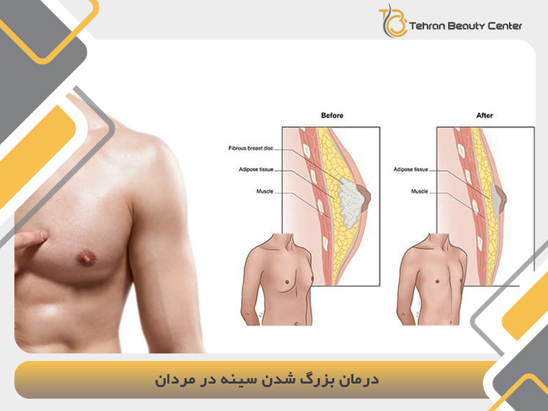 درمان بزرگ شدن سینه در مردان