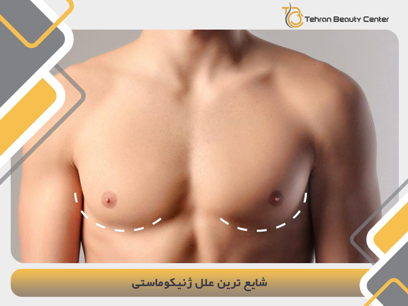 شایع ترین علل ژنیکوماستی