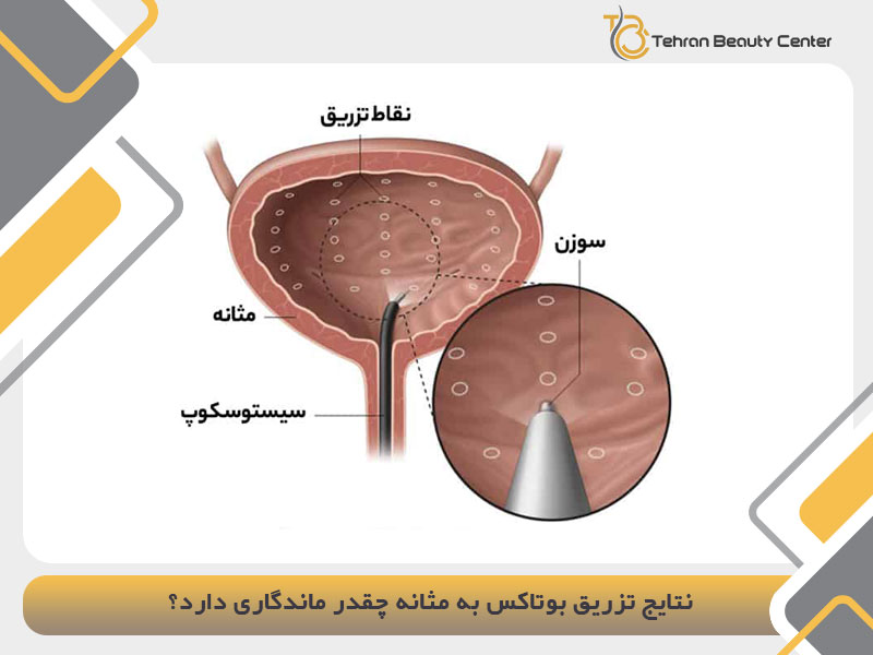 نتایج تزریق بوتاکس به مثانه چقدر ماندگاری دارد؟