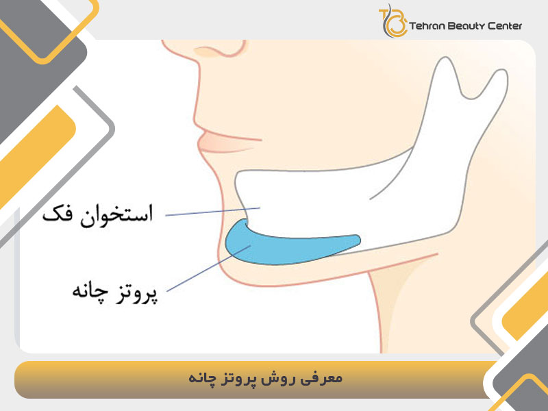 معرفی روش پروتز چانه